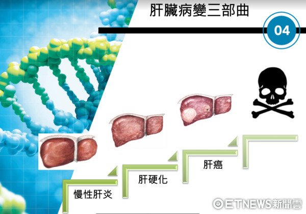▲肝癌三部曲。（圖／公關提供）