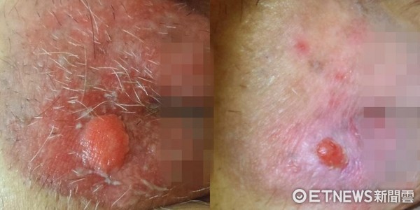 ▲外陰部1公分「大痘痘」腫痛又滲血　切片檢查竟是癌！。（圖／台北慈濟醫院提供）