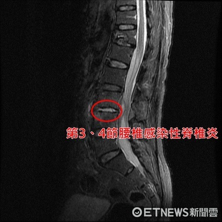 罕見！「感染性脊椎炎」上身，她下背痛臥床月餘險癱。（圖／亞大醫院提供）