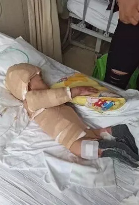 兒子燒傷，爸爸移植背不疲救小孩。（圖／翻攝自貴州都市報）