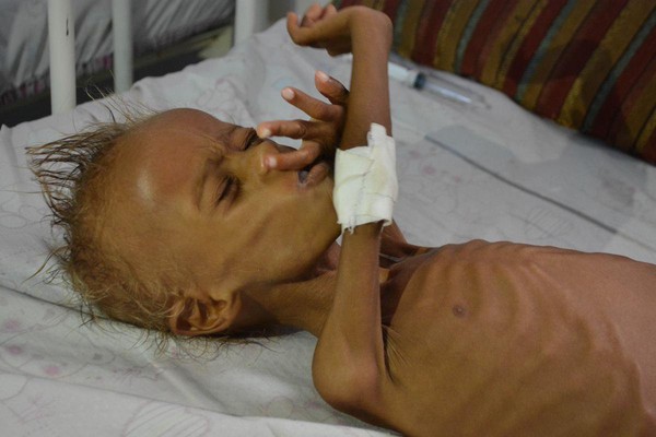 葉門持續了兩年的內戰，釀成重大人道危機，超過1700萬人面臨飢餓的威脅，圖為一名嚴重營養不良的五歲孩童躺在醫院接受治療，攝於2016年9月。（東方IC）