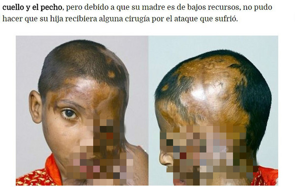 強酸潑綠帽妻卻潑到自己女兒　害4歲的她半臉融化。（圖／翻攝自《EL DEBATE》）