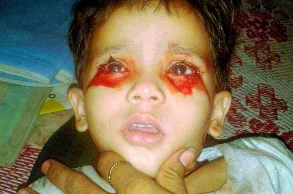 ▲3歲的阿哈娜（Ahana Afzal）每天都嚴重出血。（圖／翻攝自臉書／Robert Mensah）