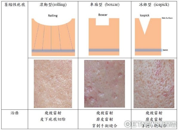 ▲臉上各種痘疤之飛梭雷射分段治療。（圖／成醫提供）