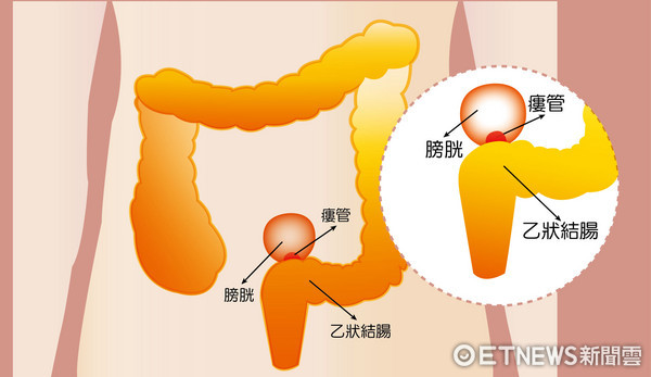 排出奇臭「粪尿」 乙状结肠憩室惹祸