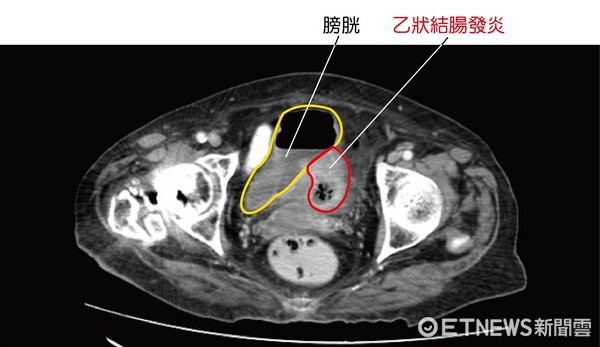 ▲乙狀結腸發炎。（圖／澄清醫院提供）