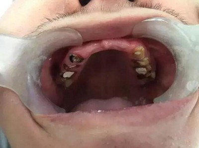 牙齿痛起来要人命 口腔保健从挑对牙膏,牙刷开始