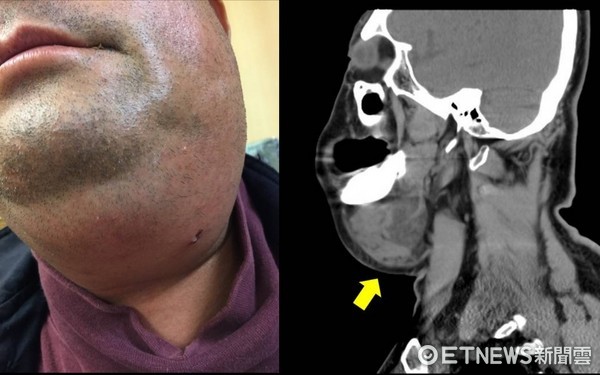 ▲拔完牙脖子腫一包,他感染這病死亡率高達70%。(圖/記者嚴云岑攝)