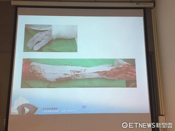 ▲燒燙傷敷料該怎麼選?從「傷口滲出液」判斷就對了!北榮整形外科彭成康主任。(圖/記者嚴云岑攝)