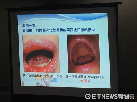 ▲口腔黏膜炎。(圖/記者嚴云岑攝)