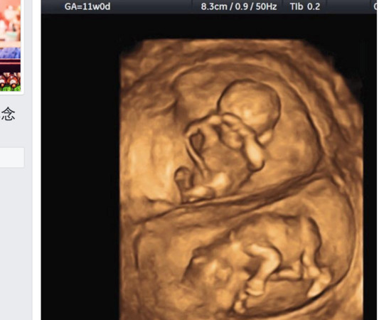 ▲懷孕未滿3個月不要說？　產科醫：有一定的道理在。（圖／翻攝蘇怡寧醫師愛碎念臉書）