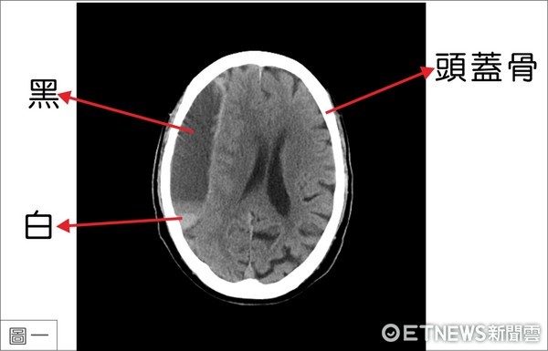 「慢性硬腦膜下出血」是老年人常見的疾病，因診斷不易，被誤診的機率高。（圖／台東基督教醫院提供）