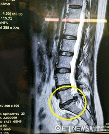 ▲患者的椎間盤被爆裂式的擠壓出脊椎前、後側。（圖／活力得中山脊椎外科醫院提供）