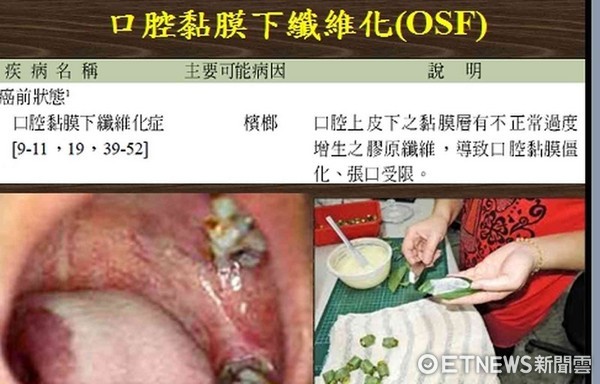 ▲口腔癌會造成纖維化，造成張口困難。（圖／記者林悅翻攝）