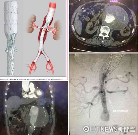 ▲80歲陳姓阿伯被診斷12公分巨大胸腹主動脈瘤。（圖／記者林悅翻攝）