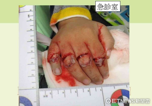 ▲小孩右手從食指到小指的壓砸傷骨折合併三度燙傷。（圖／記者林悅翻攝）