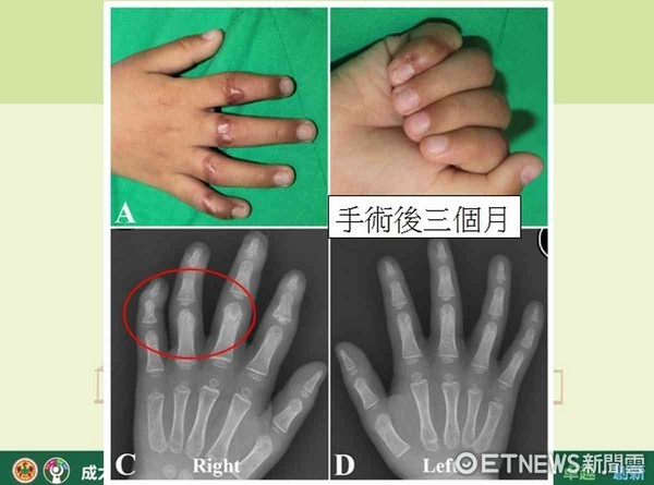 ▲術後三個月追蹤復原情況良好。（圖／記者林悅翻攝）