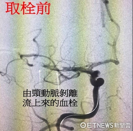 ▲咳嗽太用力「頭暈軟腳」   30多歲男竟中風「左側偏癱」。（圖／雙和醫院提供）