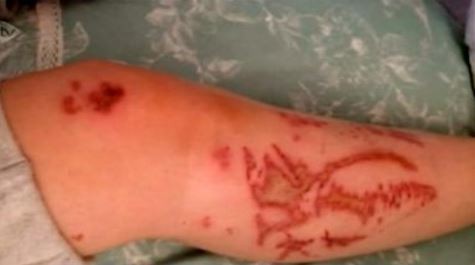 ▲▼蘇格蘭18歲少女被硫酸傷腿，上節目傾訴受害過程。（圖／翻攝自推特／@BeautifulCAzone）