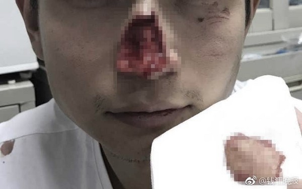 ▲杭州男遭切割機拋光盤砸臉，鼻子被削掉。（圖／翻攝自《錢江晚報》）