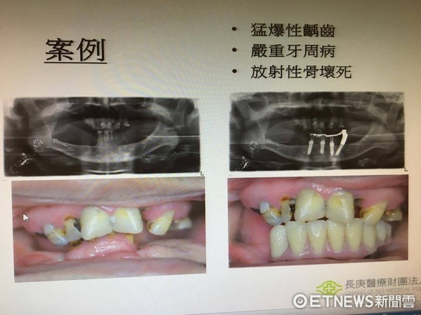 ▲研究：頭頸癌放療前2周先「護牙」　骨壞死機率大降45%。（圖／記者嚴云岑攝）