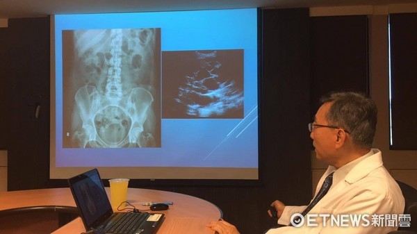 ▲26歲女腹脹斷續1年多，X光一照竟是「宿便空氣塞滿腸」。（圖／記者嚴云岑攝）