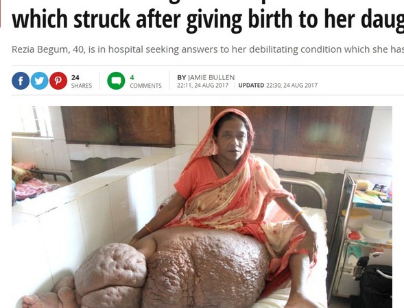 右腿腫成57公斤「象腿」　生完女兒怪病纏孟加拉婦18年。（圖／翻攝自英國鏡報）