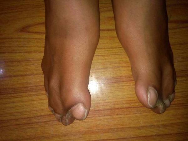 ▲▼印度8歲男童Aswanth罹患罕見遺傳疾病亞伯氏症，手腳指頭相黏。（圖／翻攝自milaap募資平台）