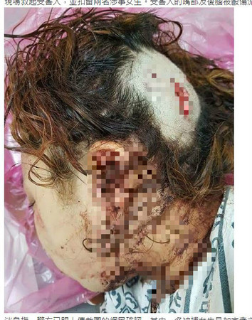 ▼少女頭部傷勢嚴重，目前在醫院治療。（圖／翻攝自LIHKG 討論區）