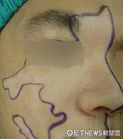 ▲手術前，白斑擴散到幾乎半張臉。（圖／光田綜合醫院提供）