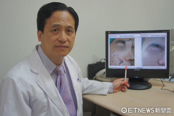 ▲光田綜合醫院整形外科主任吳文宏指出，白斑症可透過手術可治療。（圖／光田綜合醫院提供）