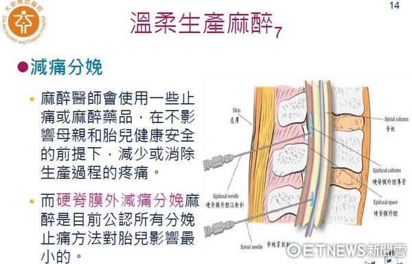 ▲硬脊膜外腔注射止痛，就是在腰椎處經由注射針放入一條導管於覆蓋脊椎的外圍硬脊膜外腔，再將局部麻醉藥注入以達到止痛效果，讓產婦在生產過程中減少產痛的感覺。（圖／記者林悅翻攝）