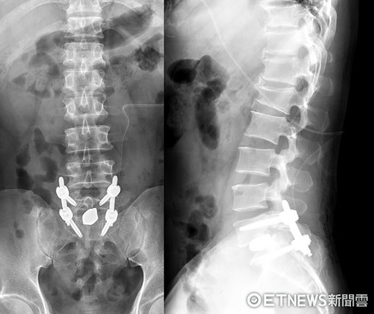 搬運工無法彎腰竟是「脊椎滑脫」。（圖／亞洲大學附屬醫院提供）