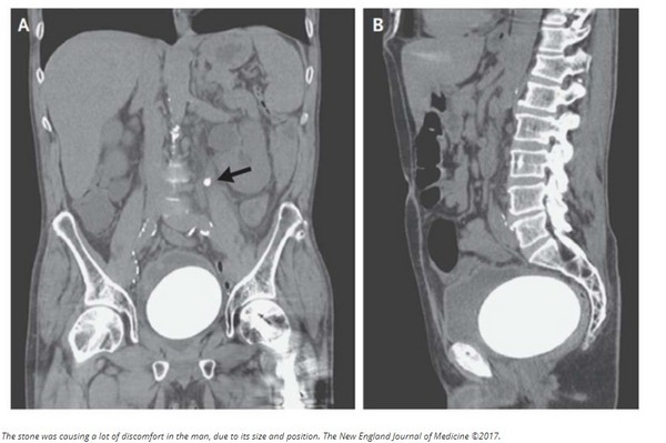 男腹痛掃描發現「下體生蛋」　膀胱結石重0.77公斤。（圖／翻攝自IFLScience／新英格蘭醫學雜誌）