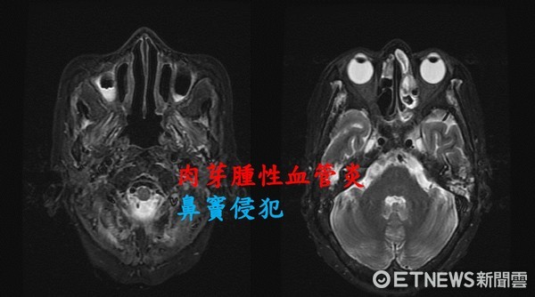 ▲患者因肉芽腫性血管炎侵犯鼻竇，造成鼻竇炎及發燒。（圖／記者林悅翻攝）