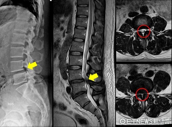 ▲患者腰椎部分有顯受到壓迫。（圖／記者林悅翻攝）