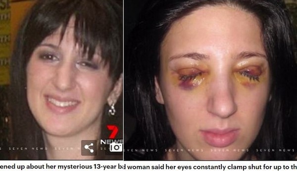 ▲澳洲女子怪病纏身13年，眼皮自動黏合「一黏就是3天」。（圖／取自每日郵報）