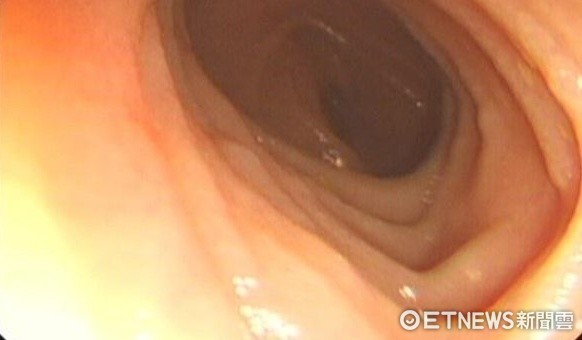 ▲「克隆氏症」肛門潰爛　她8歲開刀數十次只能「切腸保命」。（圖／公關提供）