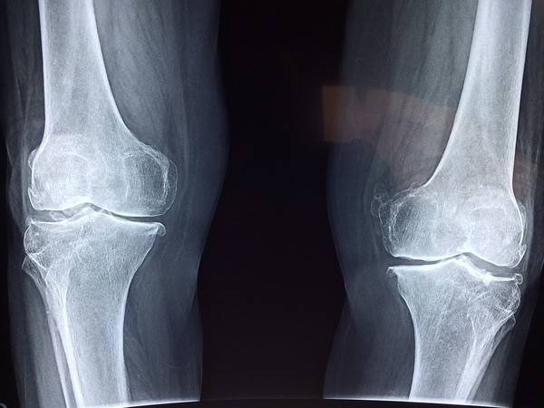 从事重覆弯曲膝盖的工作与运动,都容易造成膝盖提早磨损