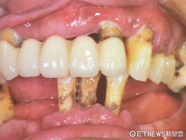 ▲牙菌斑堆積是牙周病的根源，使支撐牙齒的骨頭流失，造成牙齦萎縮，牙縫變大，嚴重會使牙根顯露出來，甚至需拔牙。（圖／記者林悅翻攝）