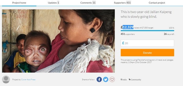 ▲患有罕病，印度2歲男童雙眼凸出。（圖／取自crowdfunder）