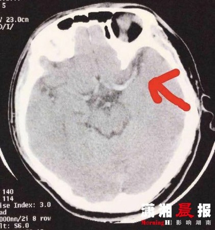 ▲▼湖南長沙21歲大學生在網咖熬戰3天3夜，結果腦中風。（圖／《瀟湘晨報》）