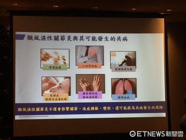 ▲類風濕關節炎。蔡文展,張玲瑗（圖／記者嚴云岑攝）