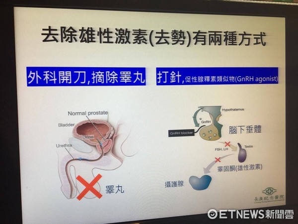 ▲攝護腺癌「切睪丸」1.5年內　心血管風險比吃藥去勢高40%。（圖／記者嚴云岑攝）