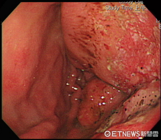 ▲這隻細菌引發「胃淋巴癌」　她隔週就胃痛...半邊胃潰爛。（圖／記者嚴云岑攝）