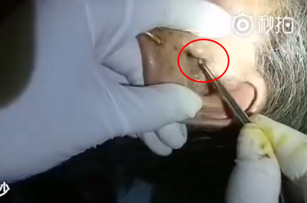 ▲▼湖南湘西一名76歲阿嬤耳朵慘遭蒼蠅飛入產卵，長出32條活蛆。（圖／翻攝自秒拍）