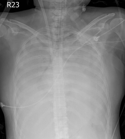 ▲流感重症住院第3天，X光片顯示嚴重肺炎，肺部浸潤，白成一片。（圖／國泰醫院提供）