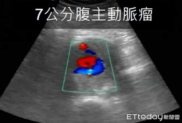 ▲急診醫師迅速進行超音波檢查，竟發現1顆7公分的腹主動脈瘤，馬上安排住院進行手術處理。（圖／記者林悅翻攝）