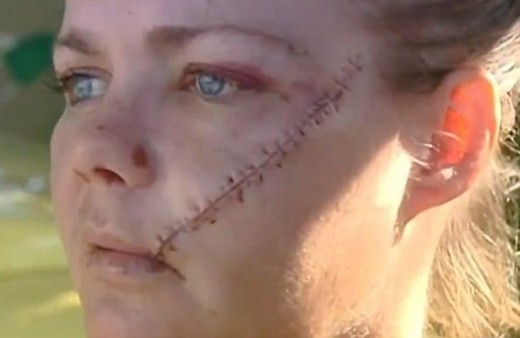▲▼澳洲夫婦遇強盜，妻子頰骨被削斷。（圖／翻攝自FB，Ingrid Brown）