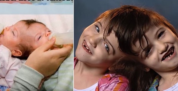 ▲加拿大「連頭雙胞胎」姊妹上月共度10歲生日。（圖／取自Youtube／The5biggest Montreal TV）